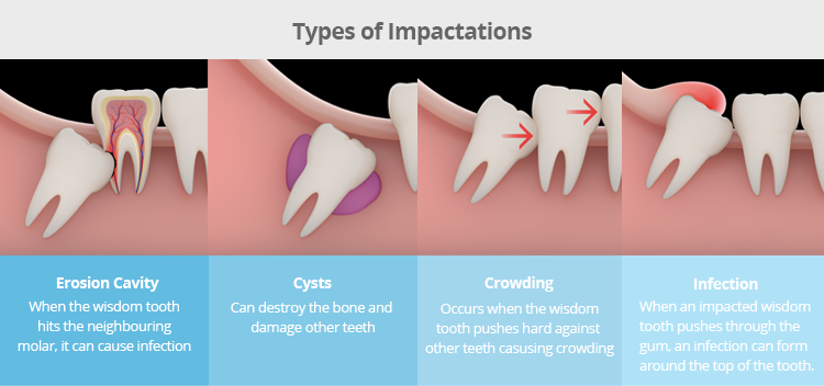 wisdom teeth impactation