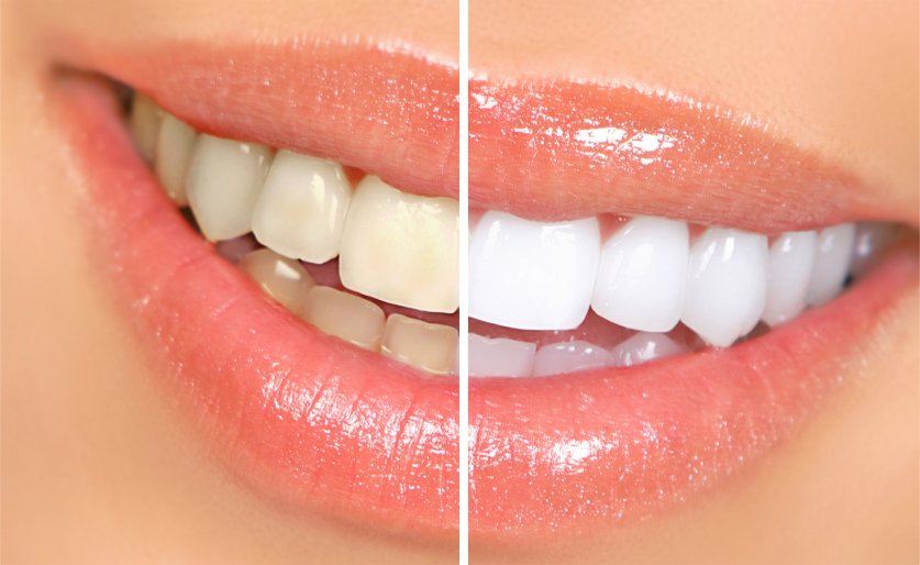 dental teeth whitening