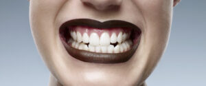 teen and teeth whitening