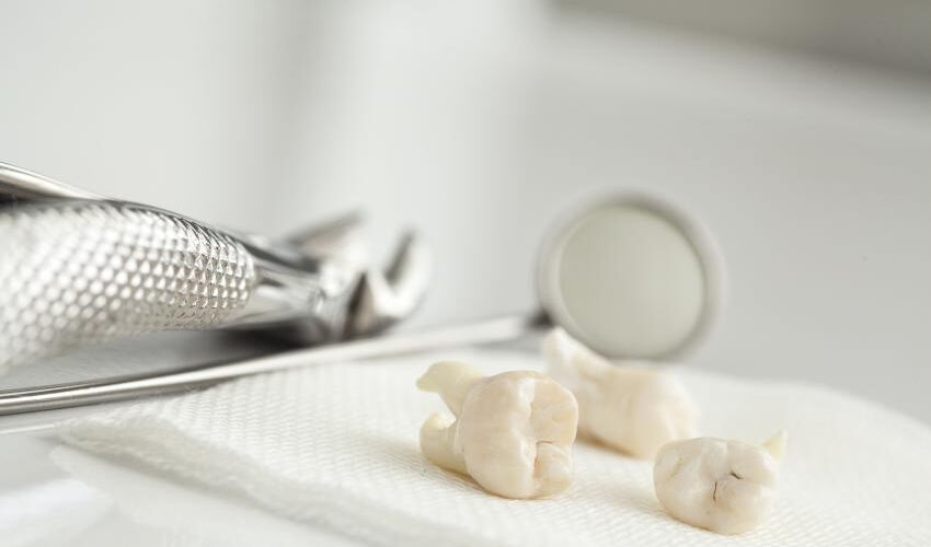 wisdom tooth extraction information