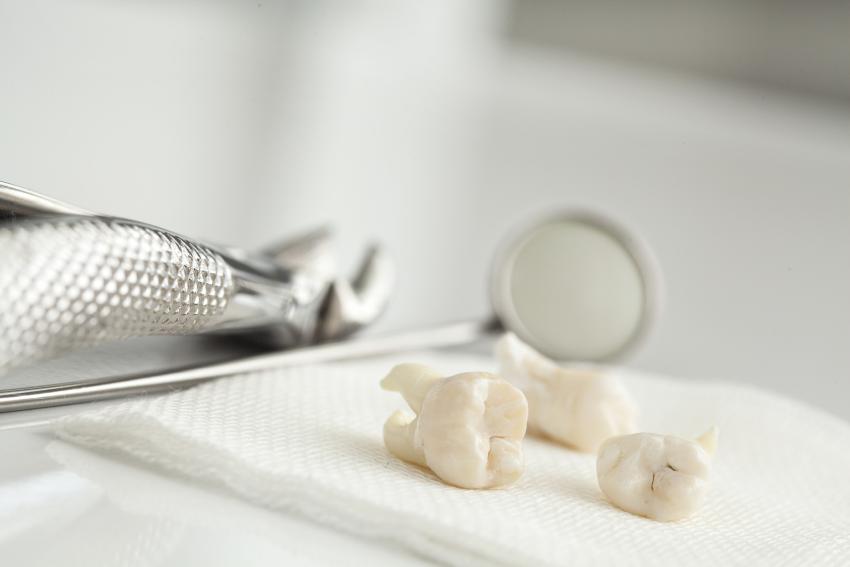 wisdom tooth extraction information