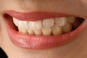 Porcelian Veneers and Cosmetic Dentistry