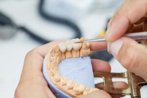 dental bridges