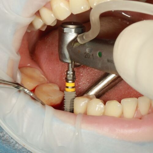 What’s the cost of dental implants ?