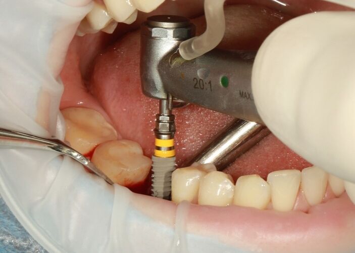 What’s the cost of dental implants ?