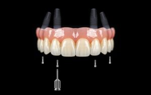 dental implants cost