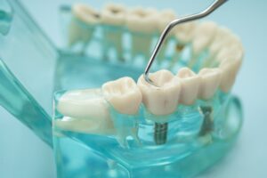 full mouth dental implants cost canada
