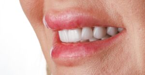teeth whitening before and after