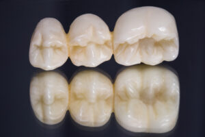 tooth implant vs dental bridge