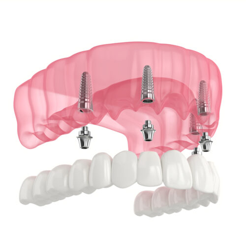 problems with snap-in dentures