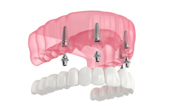 problems with snap-in dentures