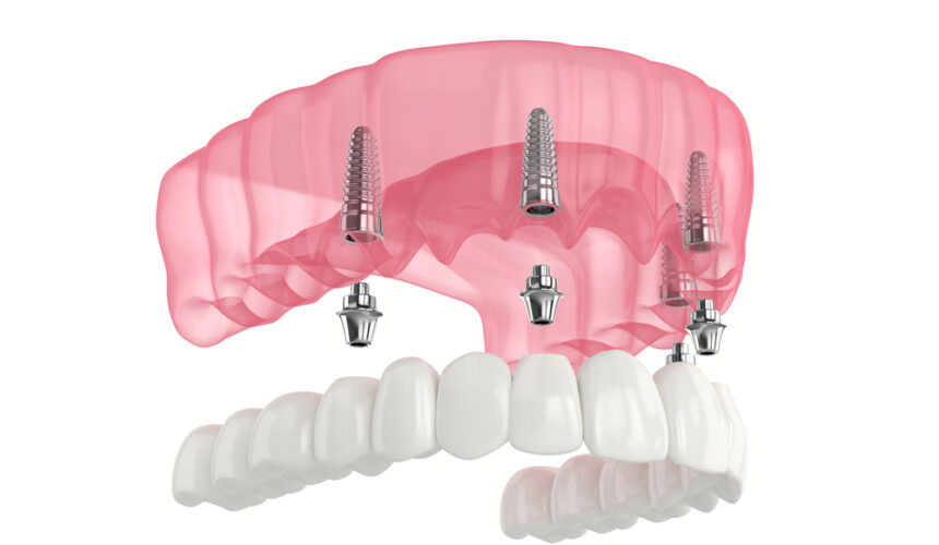 problems with snap-in dentures problems with snap-in dentures