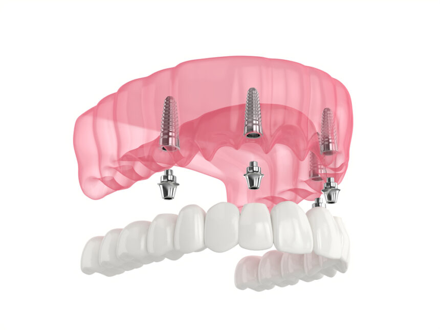 problems with snap-in dentures